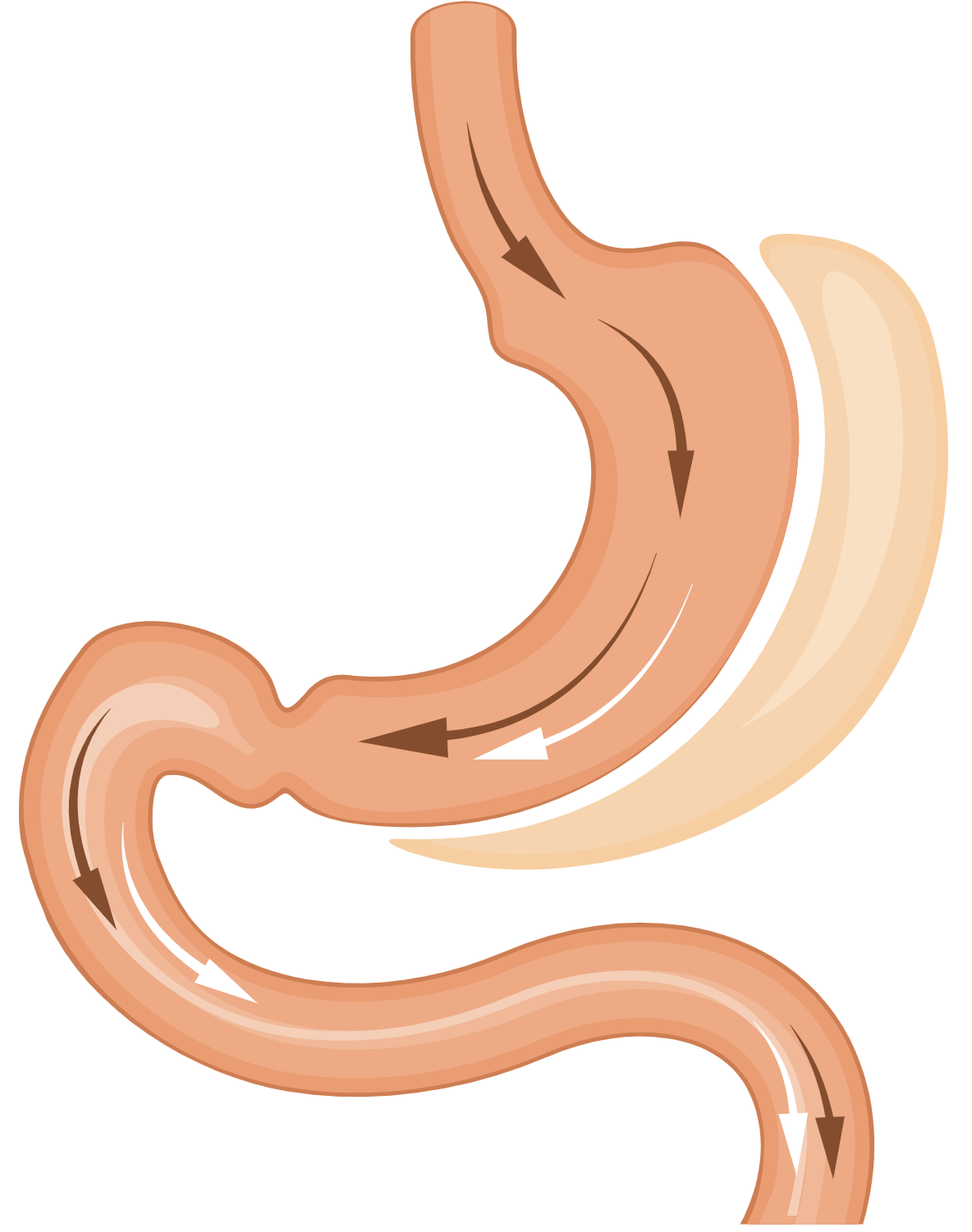 Sleeve Gastrectomy